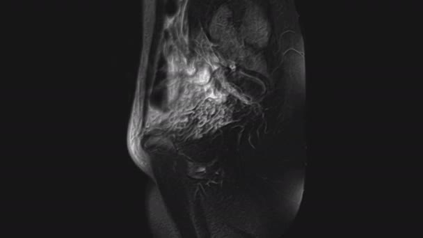 Naisen lantion elinten, vatsaontelon, ruoansulatuskanavan ja virtsarakon Voluminous MRI - Materiaali, video