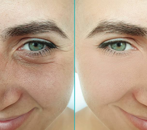 woman face wrinkles before and after treatment - Φωτογραφία, εικόνα
