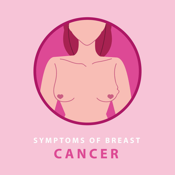 objawy raka piersi, obrzęk części piersi - Wektor, obraz
