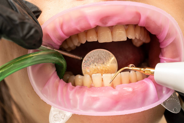 Primer plano de la herramienta removedora de placa de cálculo dental - Foto, Imagen