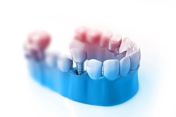 Tooth implant instalation process. 3d render - Photo, Image