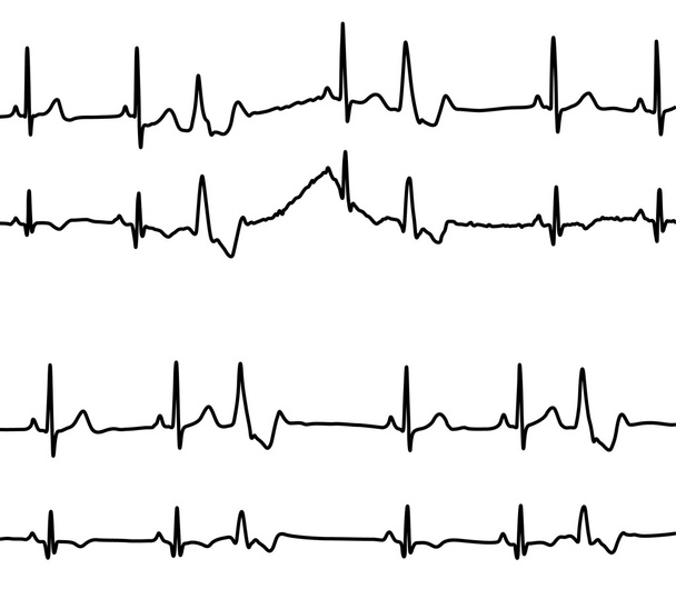 Wykresy chorób serca - Wektor, obraz