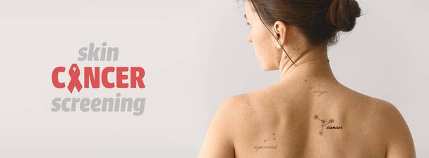 Young woman with moles on light background. Concept of skin cancer - Photo, Image