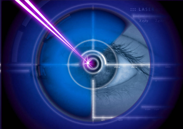  眼レーザー手術、ディオプター、眼、レーザー、補正, - 写真・画像