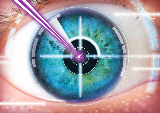  ooglaserchirurgie, diopter, oog, laser, correctie, - Foto, afbeelding