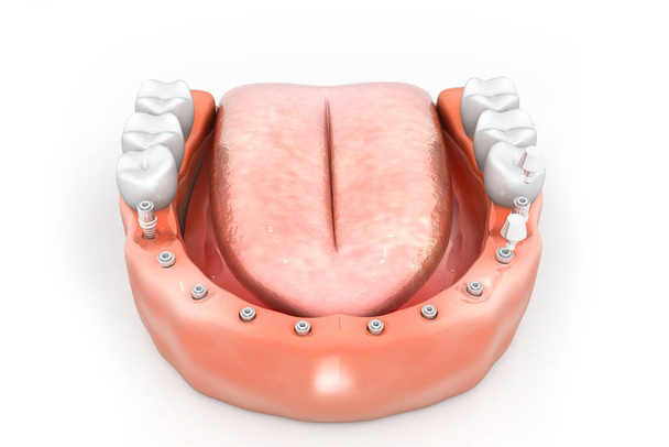 Diş implantı yerleştirme işlemi. 3d rende - Fotoğraf, Görsel