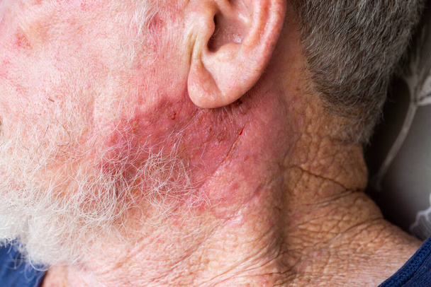 Este anciano mayor está recibiendo tratamiento de carcinoma de células basales después de una vida activa en el sol en Queensland, Australia, que tiene la tasa más alta de cáncer de piel. - Foto, Imagen