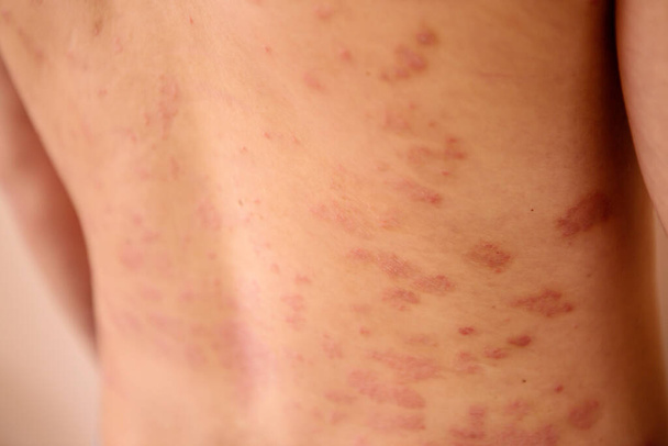 man with psoriasis all over his back and arms  - Photo, Image