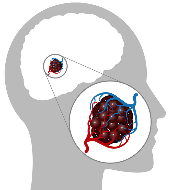 Кавернозная ангиома - это аномалия кровеносных сосудов, характеризующаяся большими соседними капиллярами с малым или вообще без вмешательства мозга. Кровоток через эти сосуды медленный. Магнитный резонанс - Вектор,изображение