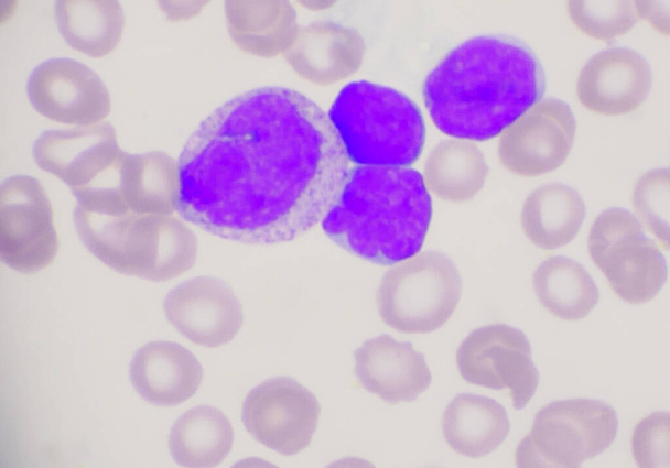 Группа взрывных клеток на фоне лейкемии. - Фото, изображение