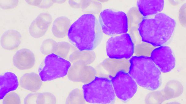Grupa komórek blastycznych w tle rozmazu krwi białaczki. - Zdjęcie, obraz