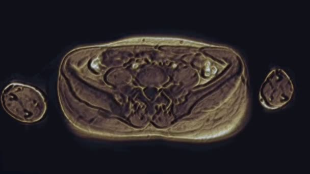 Resonancia magnética de color voluminoso de los órganos pélvicos femeninos, cavidad abdominal, tracto gastrointestinal y vejiga - Metraje, vídeo