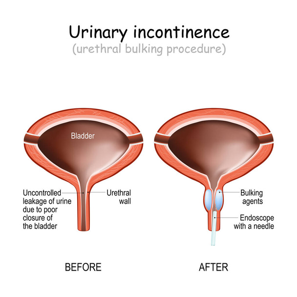 Urinary incontinence (UI), involuntary urination, is uncontrolled leakage of urine. Human urinary bladder, and Urethral bulking procedure with endoscope. - Vector, Image