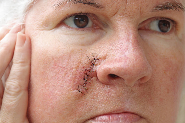 Uma mulher mais velha tem uma cicatriz cirúrgica no rosto - Foto, Imagem