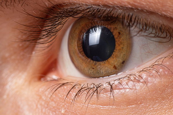 Foto macro-ocular. Ceratocone - doença ocular, afinamento da córnea na forma de um cone. O plástico da córnea. - Foto, Imagem
