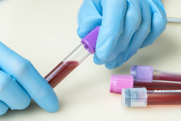 Female hands in medical blue gloves test tube with a close-up blood sample for research in a clinical laboratory. Concept of medicine, analyses - Photo, Image