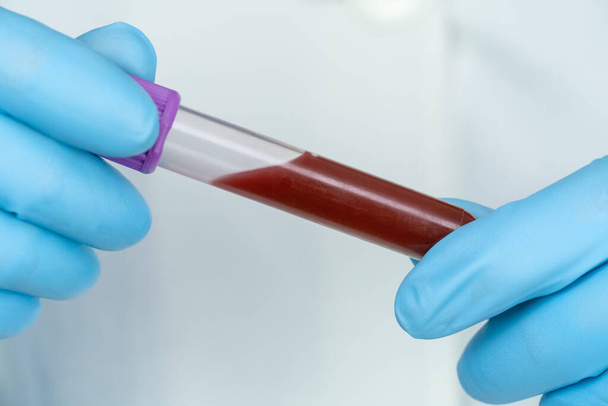 Tıbbi mavi eldiven test tüpündeki kadın eller klinik laboratuarında araştırma yapmak için yakın plan kan örneği ile birlikte. Tıp kavramı, analizler - Fotoğraf, Görsel