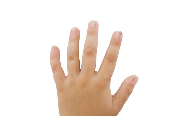 bir çocuğun işaret parmağında siğil ya da papilloma / beyaz / yakın planda izole edilmiş. - Fotoğraf, Görsel