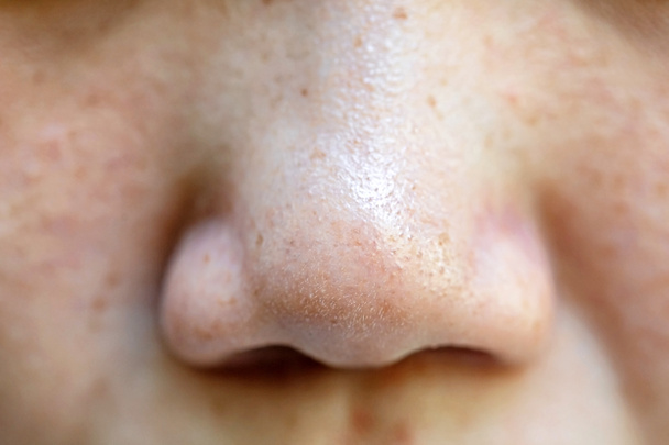 Espinhas e poros no nariz de pessoas asiáticas - Foto, Imagem
