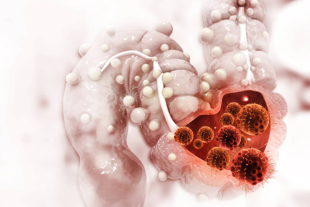 Paksusuolisyöpä. Syöpä hyökkää soluun. Paksusuolen sairaus käsite - Valokuva, kuva