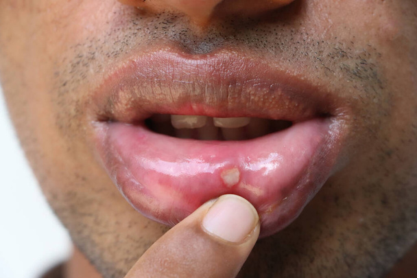 Stomatitis egy felnőtt száján. Véletlen sérülés az ajkán. - Fotó, kép