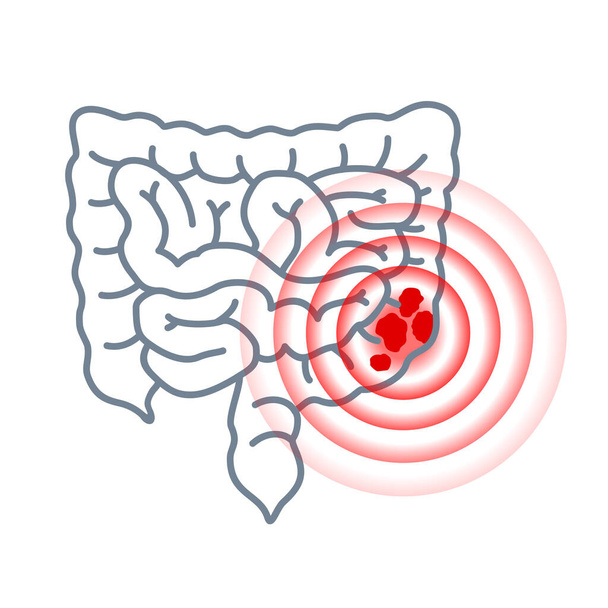 Ícone de câncer de cólon - círculos intestino e dor - Vetor, Imagem