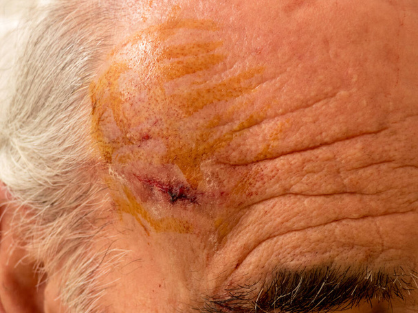 Concentrazione selettiva su dolorose lesioni rosse della fronte gonfie. Uomo anziano audace testa. - Foto, immagini