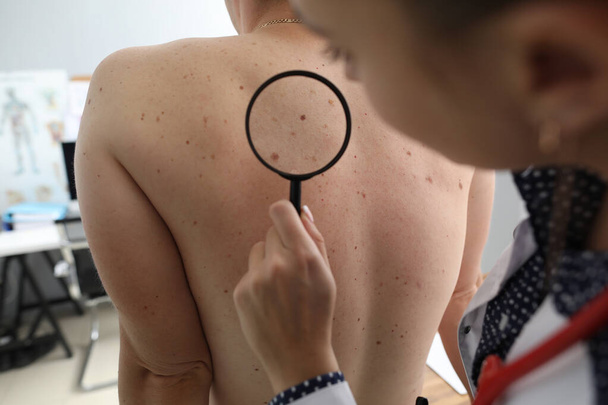 Doctor oncologist with magnifying glass in his hand examines pigmented nevi on patients back in clinic - Photo, Image