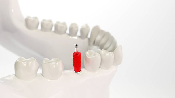 Tandheelkundig implantaat op het voorbeeld van een kaakmodel - 3D rendering - Foto, afbeelding