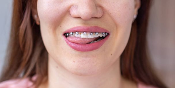 Sistema ortopédico en la boca sonriente de una chica, macrofotografía de dientes, primer plano de labios. La chica sacó su lengua - Foto, Imagen