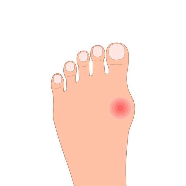 flat foot disease color icon. concept of cosmetics and procedures for feet care, medical problem, pain, painful bunion. hospital symbol for print, logo, site. simple sign isolated on white background - Vector, Image