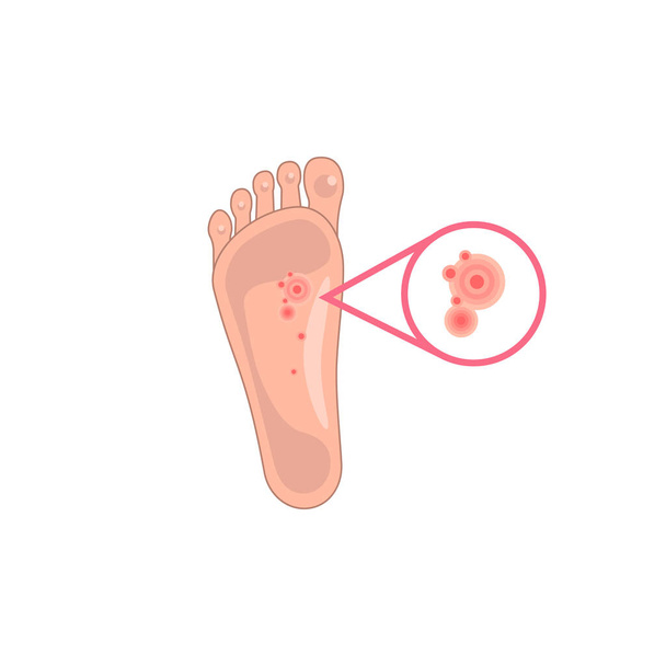 足の湿疹の増加。患者の足を皮膚炎のようなアレルギー反応で表現します。皮膚病や発疹のイメージです。医療現場やアプリのシンボルです。白地に隔離された - ベクター画像