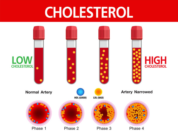 Colesterol en arteria, riesgo para la salud, diseño de vectores - Vector, Imagen