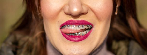 Il sistema di rinforzi nella bocca sorridente della ragazza, la macrofotografia dei denti, il primo piano delle labbra rosse. Ragazza che cammina per strada - Foto, immagini