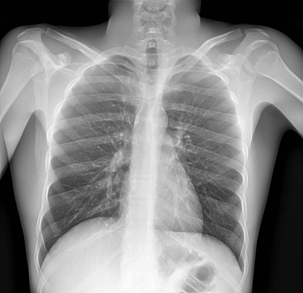 Immagine a raggi X del polmone con polmonite
. - Foto, immagini