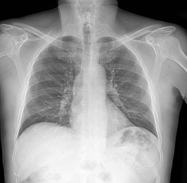 X-ray beeld van long met longontsteking. - Foto, afbeelding
