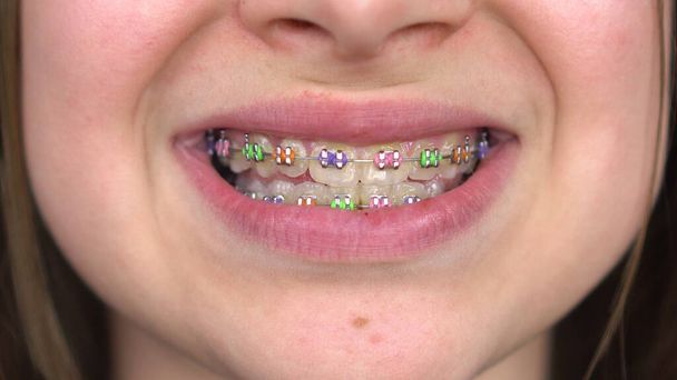 Teinityttö, jolla on hammasraudat, hymyilee lähikuva. Tyttö, jolla on värilliset raudat hampaissaan. - Valokuva, kuva