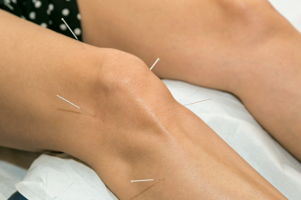 Acupuncture in the knee, osteoarthritis treatment in the knee for rehabilitation - Photo, Image
