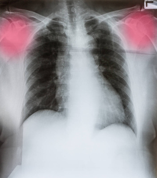 Рентгеновский снимок мужской груди - Фото, изображение