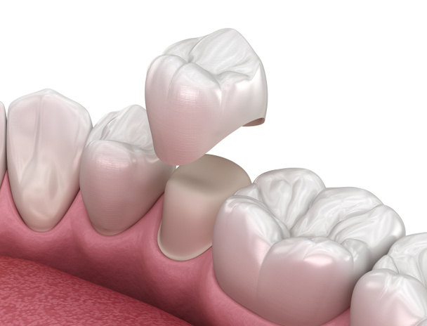 Preparato dente premolare e posizionamento corona dentale. Illustrazione 3D clinicamente accurata - Foto, immagini