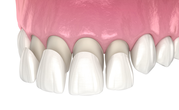 中央インジケータと横インジケータ上のベネー設置手順。医学的に正確な歯3Dイラスト - 写真・画像