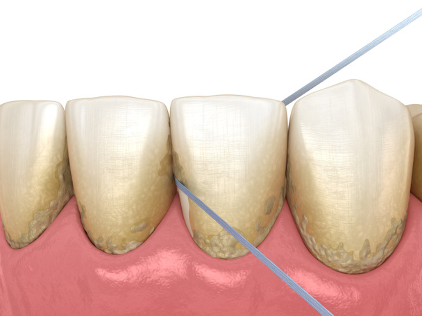 Hammaslangan puhdistusprosessi. Lääketieteellisesti tarkka hampaiden 3D-kuva - Valokuva, kuva