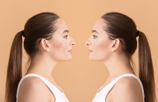Young woman before and after acne treatment on color background - 写真・画像