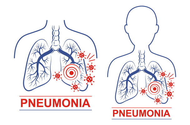 Ikona pneumonie nastavena. Lidské plíce a průdušnice anatomie. Léčím na zápal plic. Léčba koronaviru nebo bakteriálního záchvatu dýchacího ústrojí. Plochý vektor pro design balení léku - Vektor, obrázek