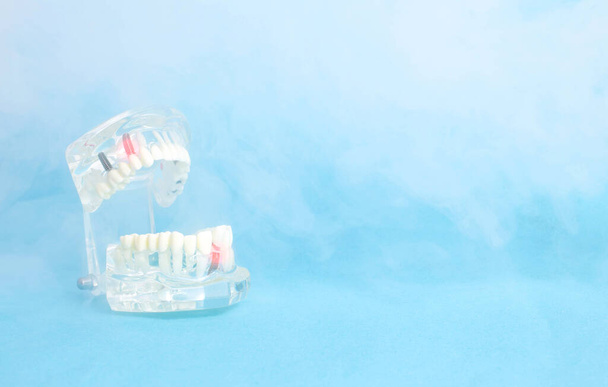 Dental jaw model on a blue background with ozone. Treatment of dental pulpitis and caries. A painless way to treat teeth and oral cavity, copy space for text - Fotografie, Obrázek