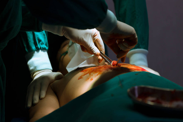 Zespół chirurgów z narzędziami chirurgicznymi wykonującymi operację klatki piersiowej na sali operacyjnej w ciężko chorych przypadkach. - Zdjęcie, obraz