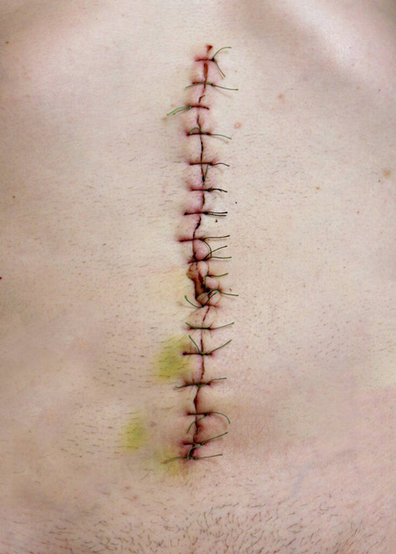 Suture chirurgicale après chirurgie de la cavité abdominale, vue rapprochée de la suture chirurgicale - Photo, image