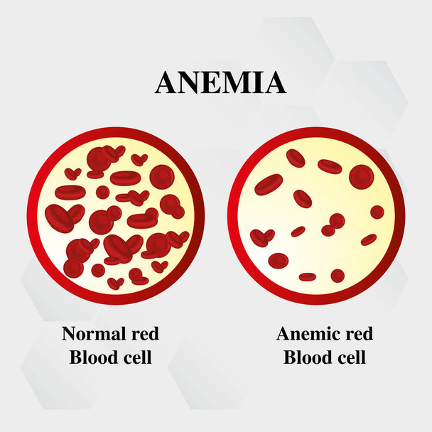 Anemia cantidad de sangre roja Hierro deficiencia anemia diferencia de Anemia cantidad de glóbulos rojos y síntomas normales vector ilustración médica. - Vector, Imagen