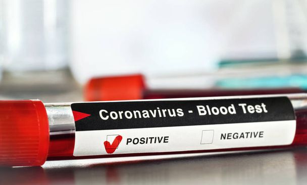 Sample vial with blood, label says coronavirus test, positive result. Blurred laboratory equipment background. Covid-19 testing during outbreak concept - Photo, image