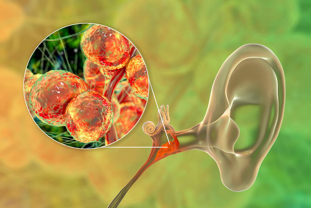 Хронічна добавка отиту, викликана грибками Candida, запальна хвороба середнього вуха, 3D ілюстрація - Фото, зображення
